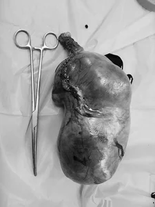 Mother Discovers Massive Four Kilogram Uterine Fibroid After Rapid Belly Growth - image 5