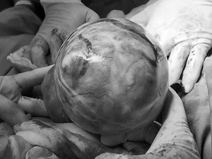 Mother Discovers Massive Four Kilogram Uterine Fibroid After Rapid Belly Growth - image 2