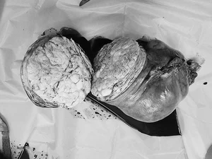 Mother Discovers Massive Four Kilogram Uterine Fibroid After Rapid Belly Growth - image 3