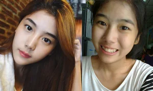 Singer Smile Parada Spends 343 Million VND to Fix Botched Nose Surgery - image 6