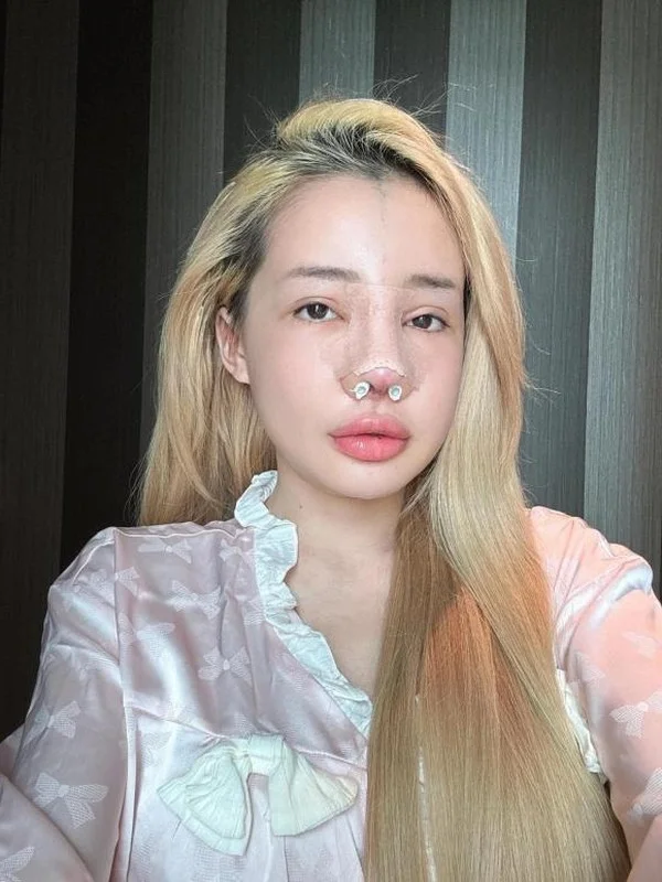 Ngan 98 Beauty Transformation Journey and 12 Nose Surgeries Analysis