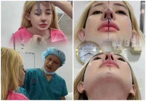 Ngan 98 Beauty Transformation Journey and 12 Nose Surgeries Analysis - image 6