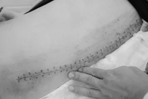 Medical Milestone: Successful 53-Degree Scoliosis Correction for 18-Year-Old Patient - image 0