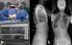 Medical Milestone: Successful 53-Degree Scoliosis Correction for 18-Year-Old Patient - image 1