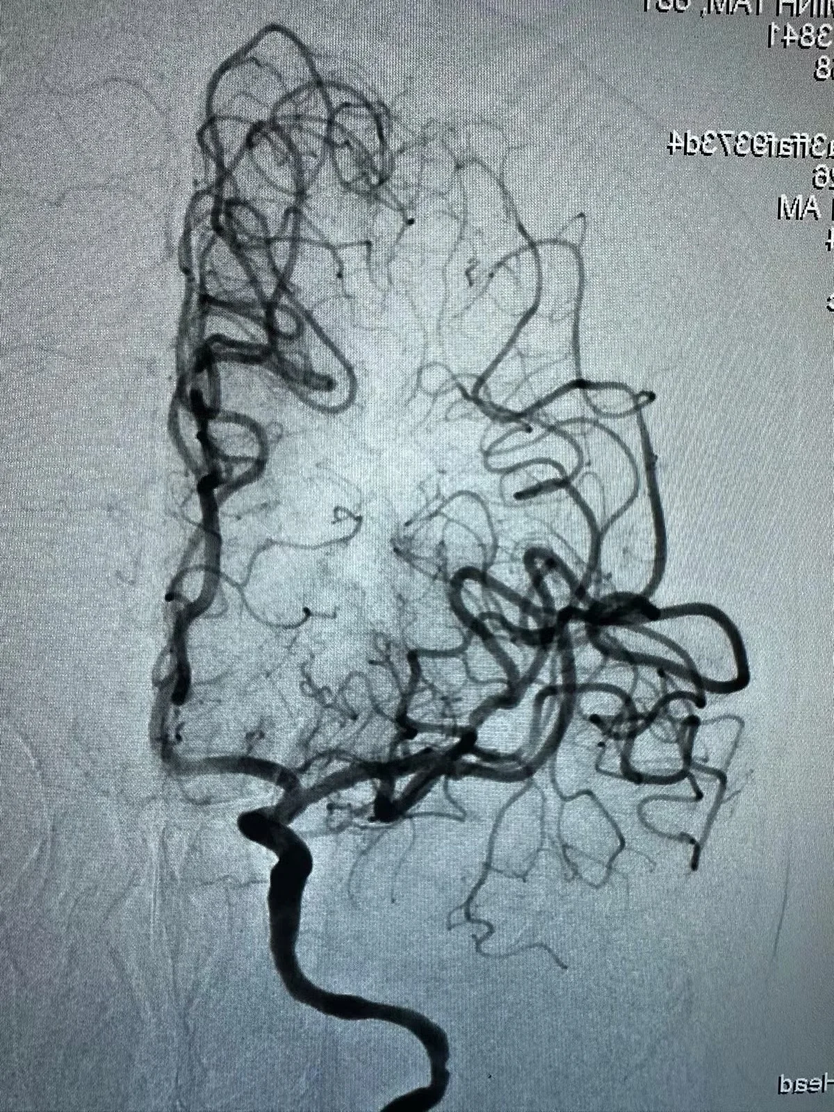 Rare Medical Case: Understanding Double Stroke in Senior Patients