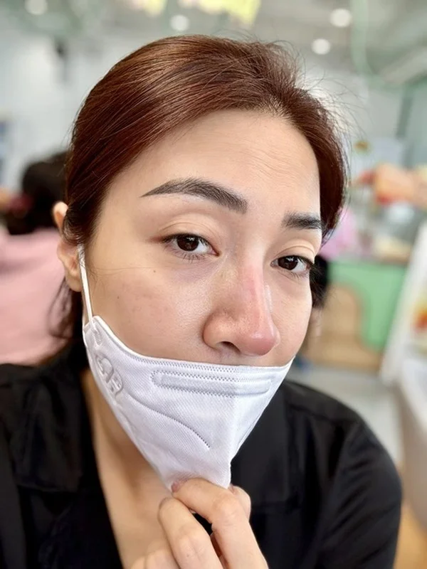 Cosmetic Surgery Risks: Vietnamese Celebrities Share Complications After Nose Jobs