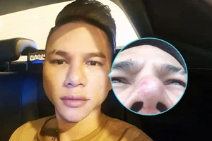 Cosmetic Surgery Risks: Vietnamese Celebrities Share Complications After Nose Jobs - image 3