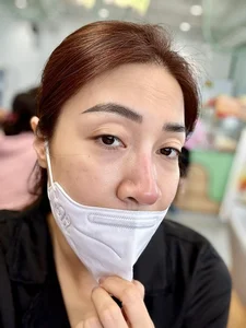 Cosmetic Surgery Risks: Vietnamese Celebrities Share Complications After Nose Jobs - image 0
