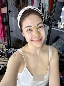 Cosmetic Surgery Risks: Vietnamese Celebrities Share Complications After Nose Jobs - image 6