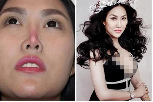 Cosmetic Surgery Risks: Vietnamese Celebrities Share Complications After Nose Jobs - image 7